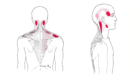 Dolor Muscular Trapecio