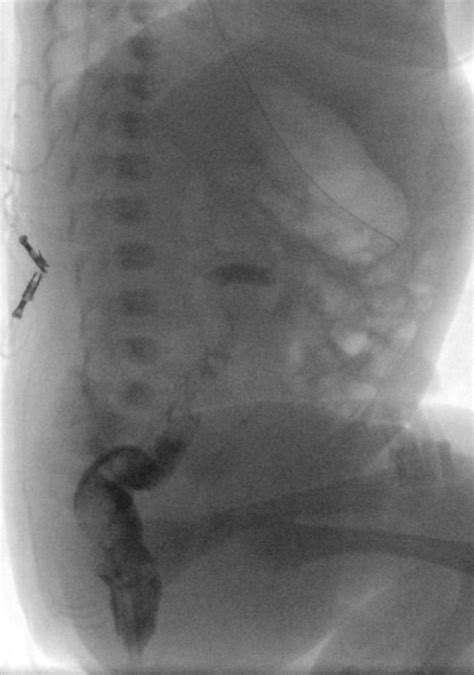 Small left colon syndrome | Image | Radiopaedia.org