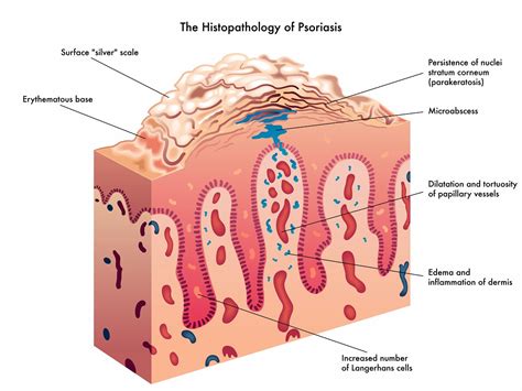 Natural Treatments for Psoriasis of the Scalp, Elbows, Hands and Feet