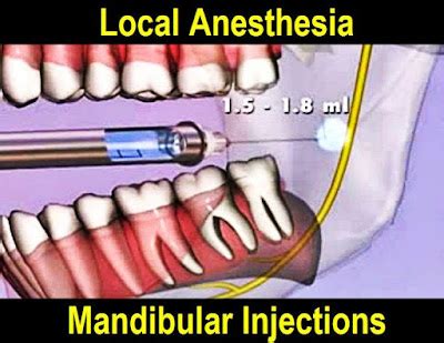 DENTAL ANESTHESIA: Mandibular Injections step by step - Odonto-Tv