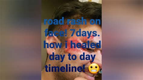 How Long Does Road Rash Take to Heal - eBikeAI