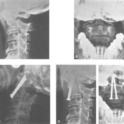 Patient 14. Type 2 fracture with the dens displaced posteriorly (A ...