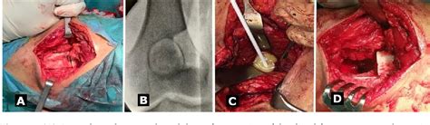 Figure 2 from Rare Intercondylar Distal Femoral Brodie’s Abscess in a 21-Year-Old Man Who ...