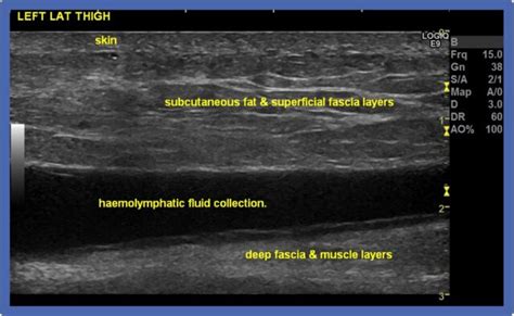 Morel-Lavallee Lesions - Diagnosis and practical management of these troublesome injuries ...