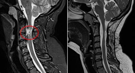 Spinal tumor case study: Mass blocked 90% of canal - Norton Healthcare Provider Louisville, Ky.