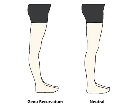 Genu Recurvatum - Mississauga and Oakville Chiropractor and Physiotherapy Clinic - FREE Consult!