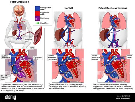 Congenital Heart Defects Types