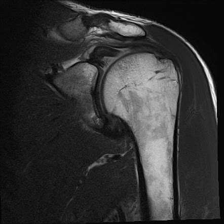 Proximal rupture of long head biceps brachii tendon | Radiology Case ...