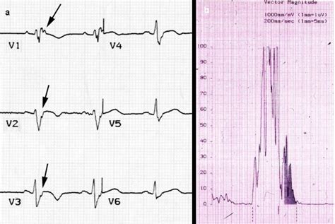 Pedi cardiology: EKG: Epsilon Wave