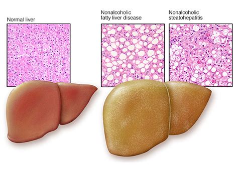 Fatty liver: Types, Symptoms, Causes and other Risk factors