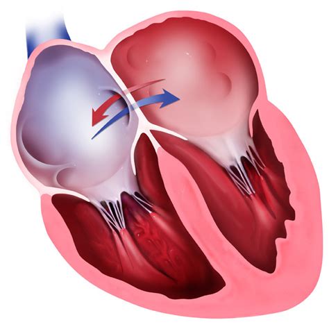 Atrial Septal Defect Newborn - Figure 2 from Atrial septal defects ...