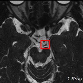 (PDF) High-resolution magnetic resonance imaging in isolated, traumatic ...