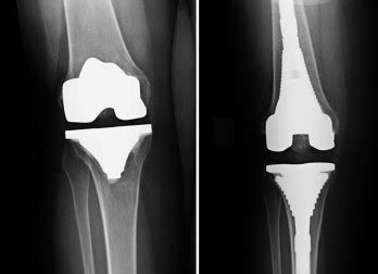 Revision Total Knee Replacement - OrthoInfo - AAOS