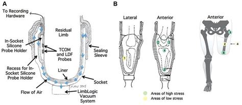 Residual Limb Health and Prosthetics | IntechOpen