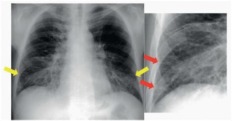 Pulmonary Edema (Interstitial) | Radiology Key