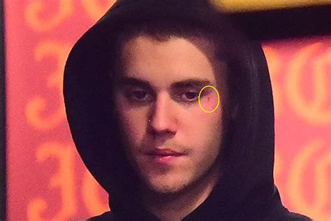 Justin Bieber Gets a Face Tattoo: Check Out His Latest Ink