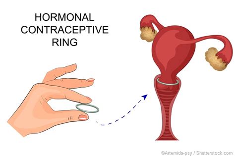 Advantages and Disadvantages of the Contraceptive Vaginal Ring - Hoffie.net