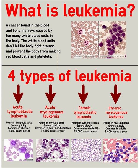 Classification of Leukemia - MEDizzy