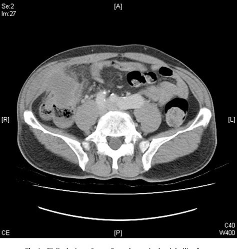 Figure 1 from Colocutaneous fistula secondary to amoebiasis. | Semantic Scholar