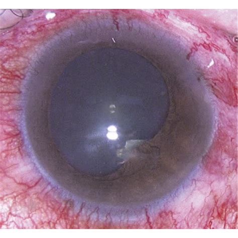 Patient 1 with iris posterior synechiae and corneal suture. (a ...