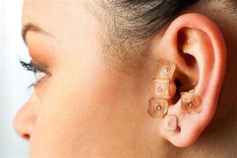 Ear acupuncture effective at improving, maintaining effectiveness of substance abuse treatment ...