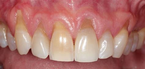 Receding Gum Treatment Archives | Implant Perio CENTER