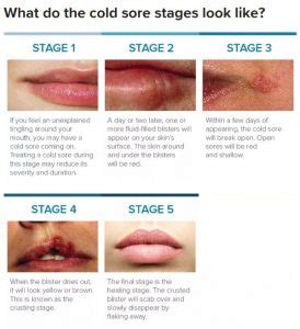 Cold Sore Stages (with Pictures) - The 5 Stages of Cold Sore Outbreak