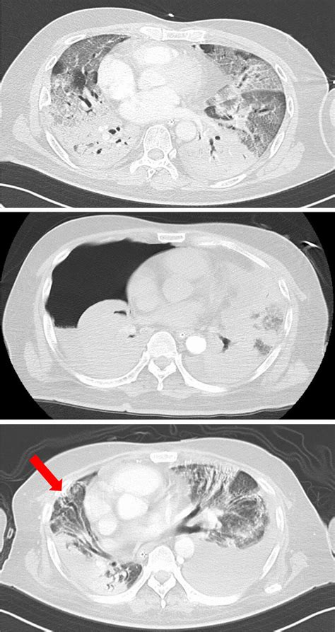 Imaging course of one patient demonstrating PTX without PM, caused by... | Download Scientific ...