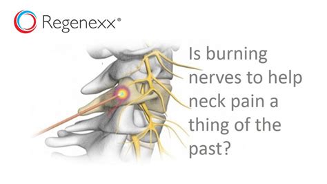 Neck Nerve Ablation: Why Ablate When You Can Regenerate? - Regenexx®