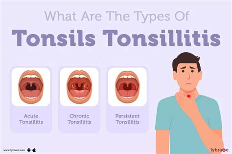 Tonsillitis Types, Causes, Symptoms, Complications,, 57% OFF