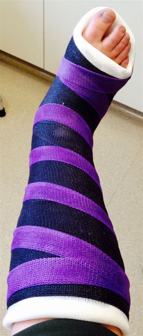 My spiffy new cast which my daughter has dubbed the "Cheshire Cast." Ankle Cast, Leg Cast ...