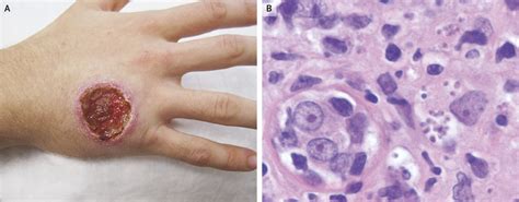 Case of Cutaneous Leishmaniasis reported in NEJM