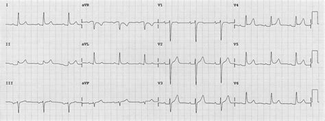 ECG (EKG) examples and quiz - Oxford Medical Education