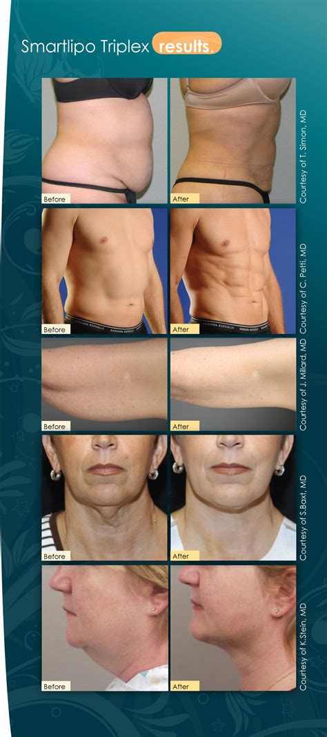 Smartlipo Triplex™ before & after images. Carolina Laser & Cosmetic Center in Winston Salem, NC ...