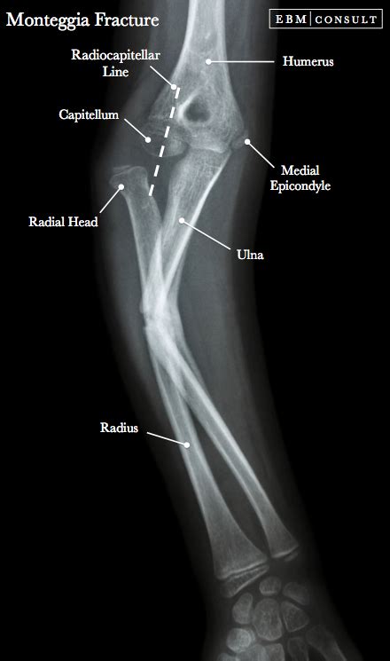 Monteggia Fracture - Ulnar fracture & Radial Head Dislocation ...