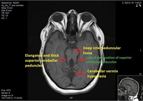 An elusive ciliopathy: Joubert syndrome | BMJ Case Reports