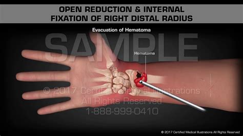 Patella open reduction internal fixation - herypayments