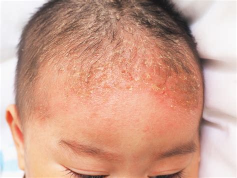 What is Seborrheic Dermatitis? Symptoms and Treatments - Facty Health