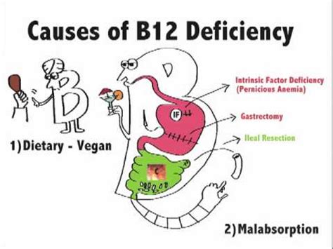 Causes of B12 Deficiency - YouTube