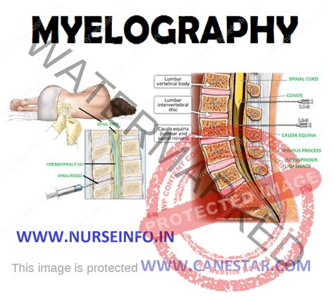 MYELOGRAPHY - Nurse Info