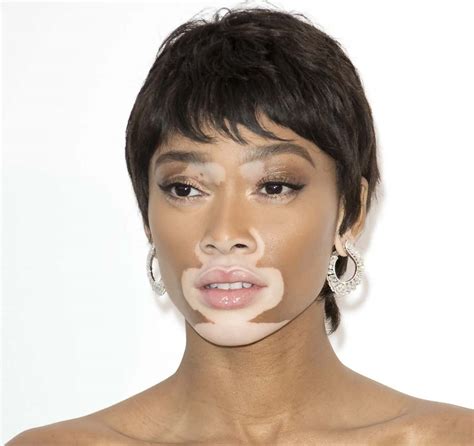 Bursting The Myths Associated With Vitiligo | 99 Health Ideas