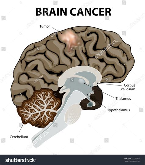 Ein Hirntumor ist ein abnormales Wachstum: Stock-Vektorgrafik (Lizenzfrei) 230065750 | Shutterstock