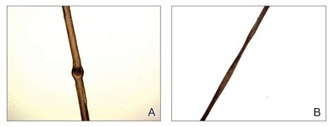 Netherton Syndrome: An Atypical Presentation | MDedge Dermatology