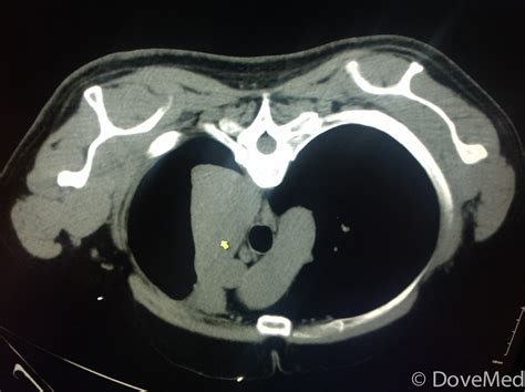 Squamous Cell Carcinoma of Lung