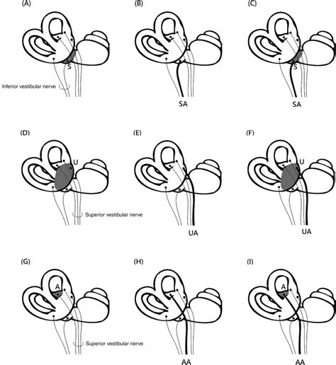 The involvements of the vestibular system, such as saccule (S),... | Download Scientific Diagram