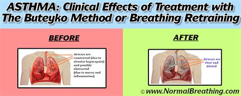 Buteyko Method for Asthma, Chronic bronchitis, Influenza and Cold ...