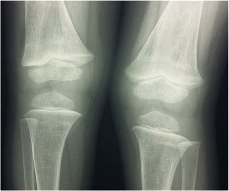 Radiological findings at the knees showing slight increased width of ...