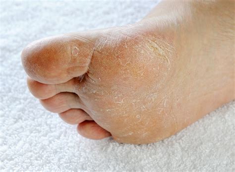 Athlete's Foot Treatment | U.S. Dermatology Partners