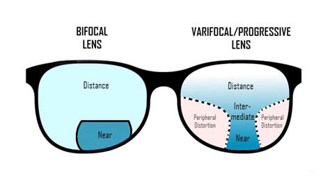 Progressive Lenses Vs. Bifocal Lenses - Endmyopia®