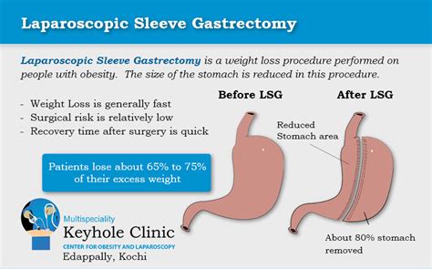 Laparoscopic Sleeve Gastrectomy India - Keyhole Clinic Kochi Kerala